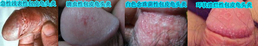 阴茎上长红斑是怎么回事?